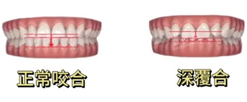 正常咬合和深覆合对比 正常咬合和深覆合对比