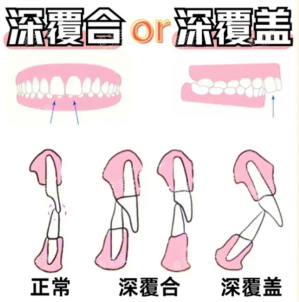 深覆合跟深覆盖的区别 深覆合跟深覆盖的区别
