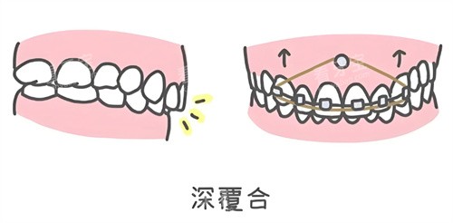 深覆合矫正 深覆合矫正