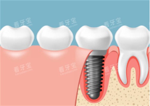 种植牙在口腔剖面图 种植牙在口腔剖面图