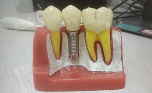 广州欧迈口腔种植牙模型图 广州欧迈口腔种植牙模型图