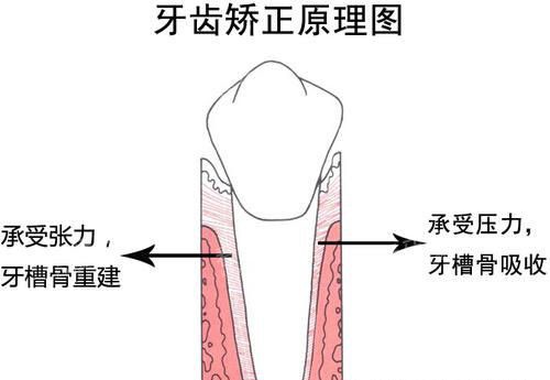 牙齿矫正正畸原理 牙齿矫正正畸原理