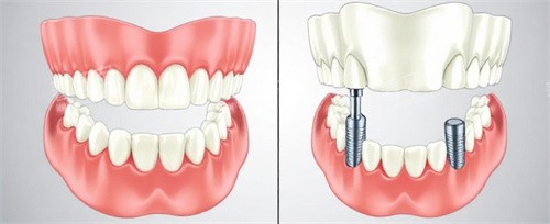 种植牙前后动画 种植牙前后动画