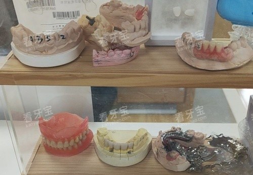 青岛爱牙联合口腔假牙模型示意图 青岛爱牙联合口腔假牙模型示意图