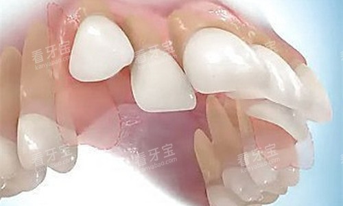 牙齿突兀卡通图 牙齿突兀卡通图