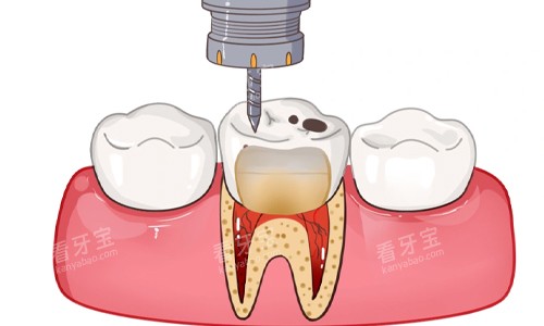 清除牙齿龋坏部分展示 清除牙齿龋坏部分展示