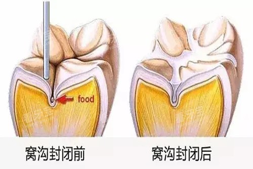 牙齿窝沟封闭前后对比卡通示意图 牙齿窝沟封闭前后对比卡通示意图