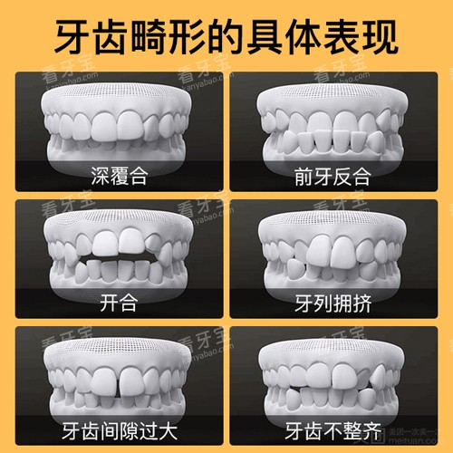 牙齿畸形形式 牙齿畸形形式