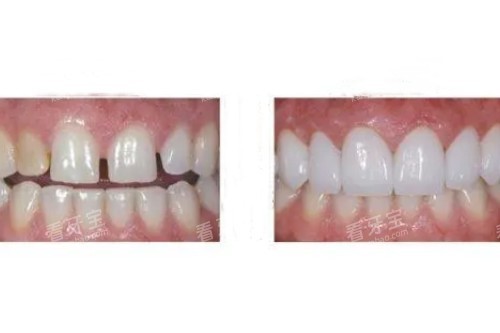 牙齿贴面修复卡通图 牙齿贴面修复卡通图