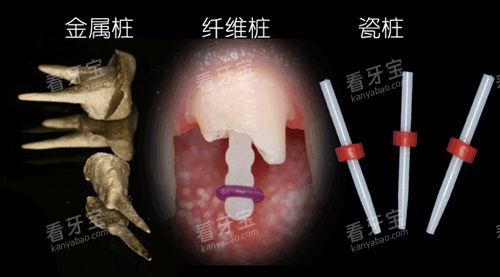 牙齿打桩材质 牙齿打桩材质