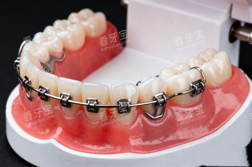 传统牙齿矫正器模型展示 传统牙齿矫正器模型展示