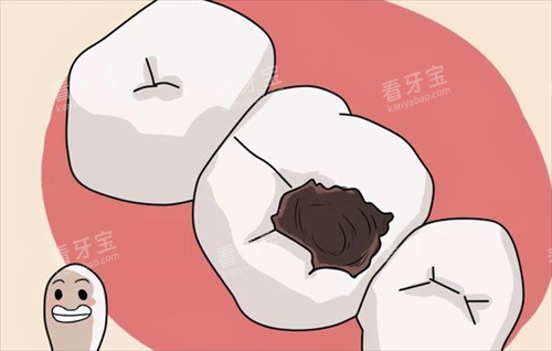 龋齿图片:重度龋齿动画展示 龋齿图片:重度龋齿动画展示