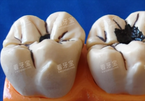 轻度和重度龋齿模型展示 轻度和重度龋齿模型展示