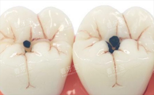 龋齿图片:牙齿模型展示 龋齿图片:牙齿模型展示