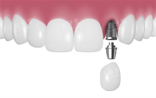 前牙区种植牙示意图 前牙区种植牙示意图