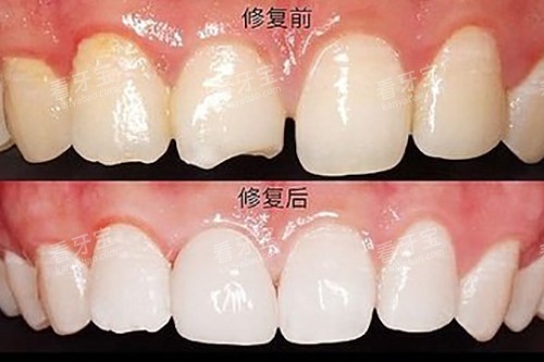 牙齿贴面对比示意图 牙齿贴面对比示意图