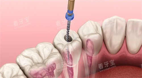 根管治疗动画示意图 根管治疗动画示意图
