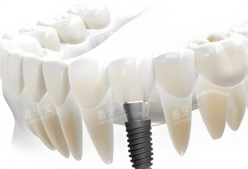 种植牙卡通展示展示图 种植牙卡通展示展示图