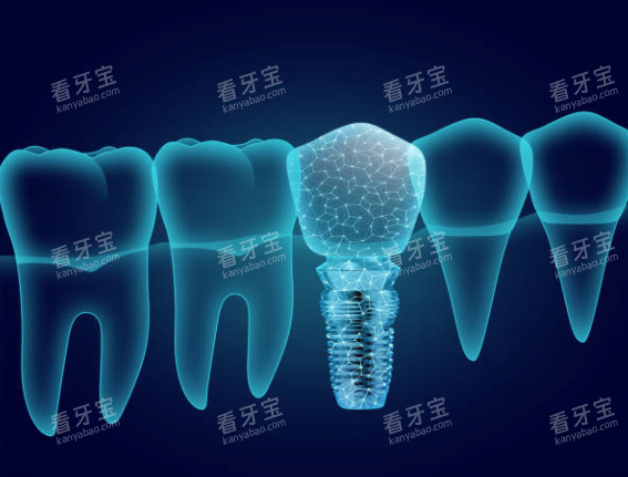 种植牙模型图卡通图 种植牙模型图卡通图