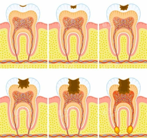 需要根管治疗的牙齿 需要根管治疗的牙齿