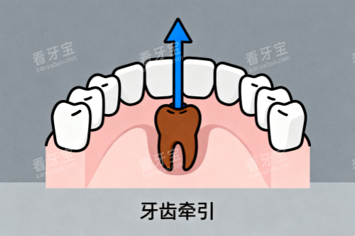 牙齿牵引卡通图 牙齿牵引卡通图