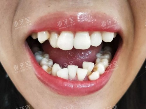 牙齿拥挤照片 牙齿拥挤照片