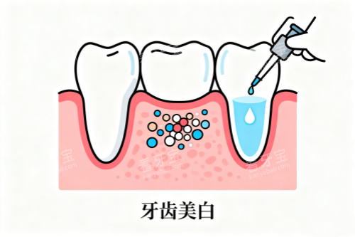 牙齿美白卡通展示图 牙齿美白卡通展示图