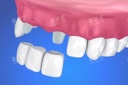 镶牙具体安装图 镶牙具体安装图