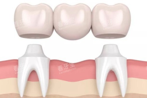 镶牙卡通展示图 镶牙卡通展示图