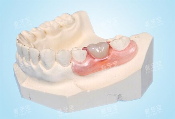 镶牙示意图 镶牙示意图