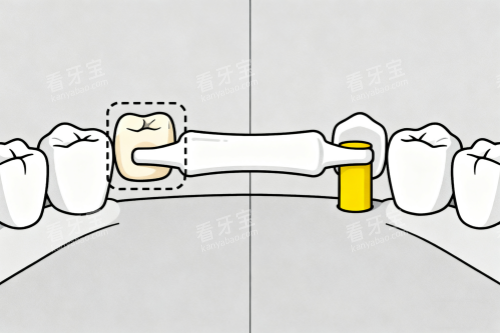 镶牙卡通展示图 镶牙卡通展示图