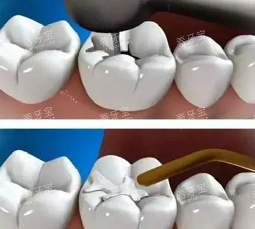 补牙过程示意图 补牙过程示意图