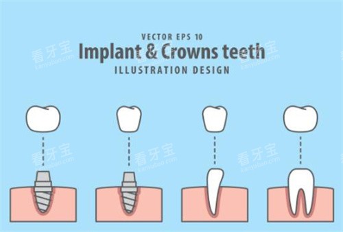 牙齿种植过程图示意图 牙齿种植过程图示意图