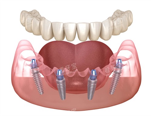 半口种植牙动画图示 半口种植牙动画图示