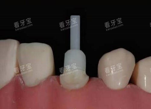 牙齿打桩流程 牙齿打桩流程