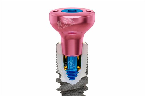 种植牙基台透视图 种植牙基台透视图