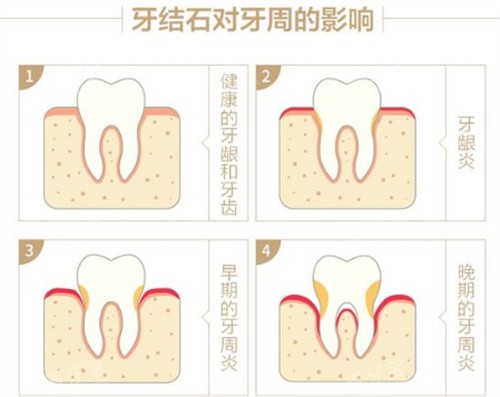 ����ʯ�����ܵ�Ӱ��