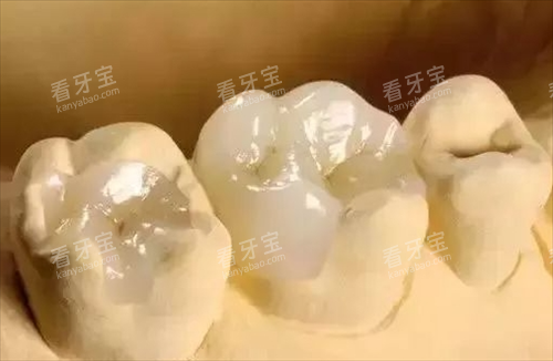 补牙模型展示图 补牙模型展示图