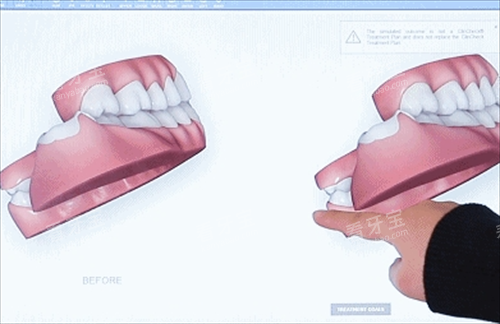 隐形牙齿矫正3D模型展示 隐形牙齿矫正3D模型展示
