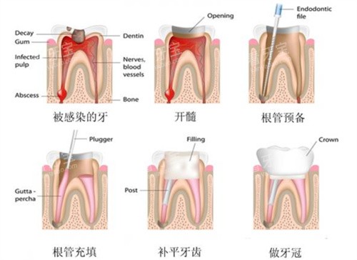 根管治疗过程图片卡通 根管治疗过程图片卡通