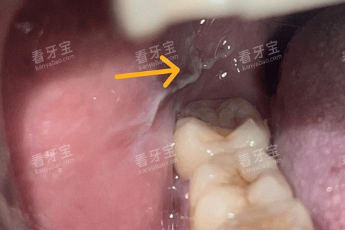 ���ݰ�ɫαĤʾ��ͼ