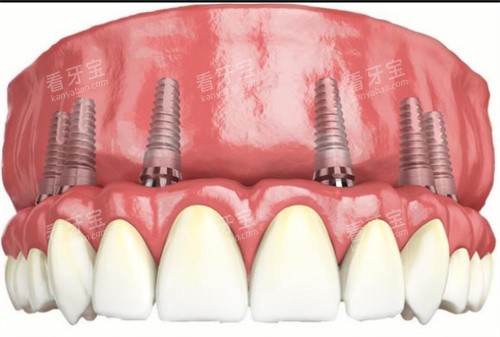 ȫ����ֲ������ʾ��ͼ