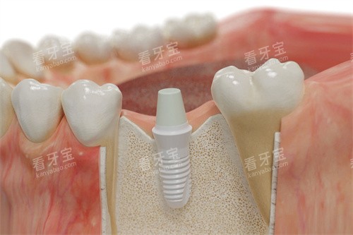 �¹�SKY��ֲ��ֲ��ģ��ͼ