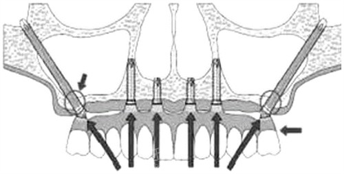 穿颧穿翼种植牙示意图 穿颧穿翼种植牙示意图