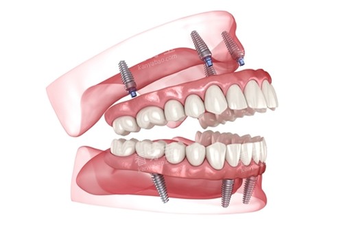 all-on-4ȫ����ֲ��ģ��ͼ