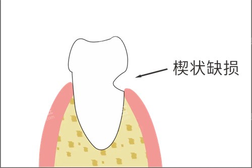 ����Ш״ȱ������ʾ��ͼ