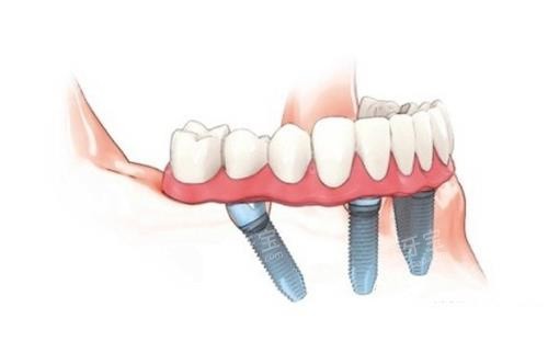 �����ֲ����ʾ��ͼ