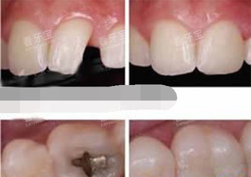 补牙过程 补牙过程