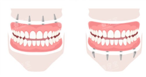 上半口种植牙和下半口种植牙 上半口种植牙和下半口种植牙