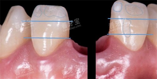 asc全瓷角度基台一体冠 asc全瓷角度基台一体冠